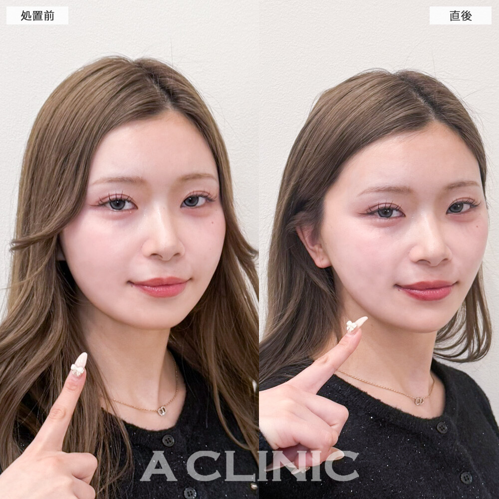 Aスレッドでバブみを残しながらもフェイスラインのもたつきを解消しました！こちら処置前と直後の症例です(20代女性)