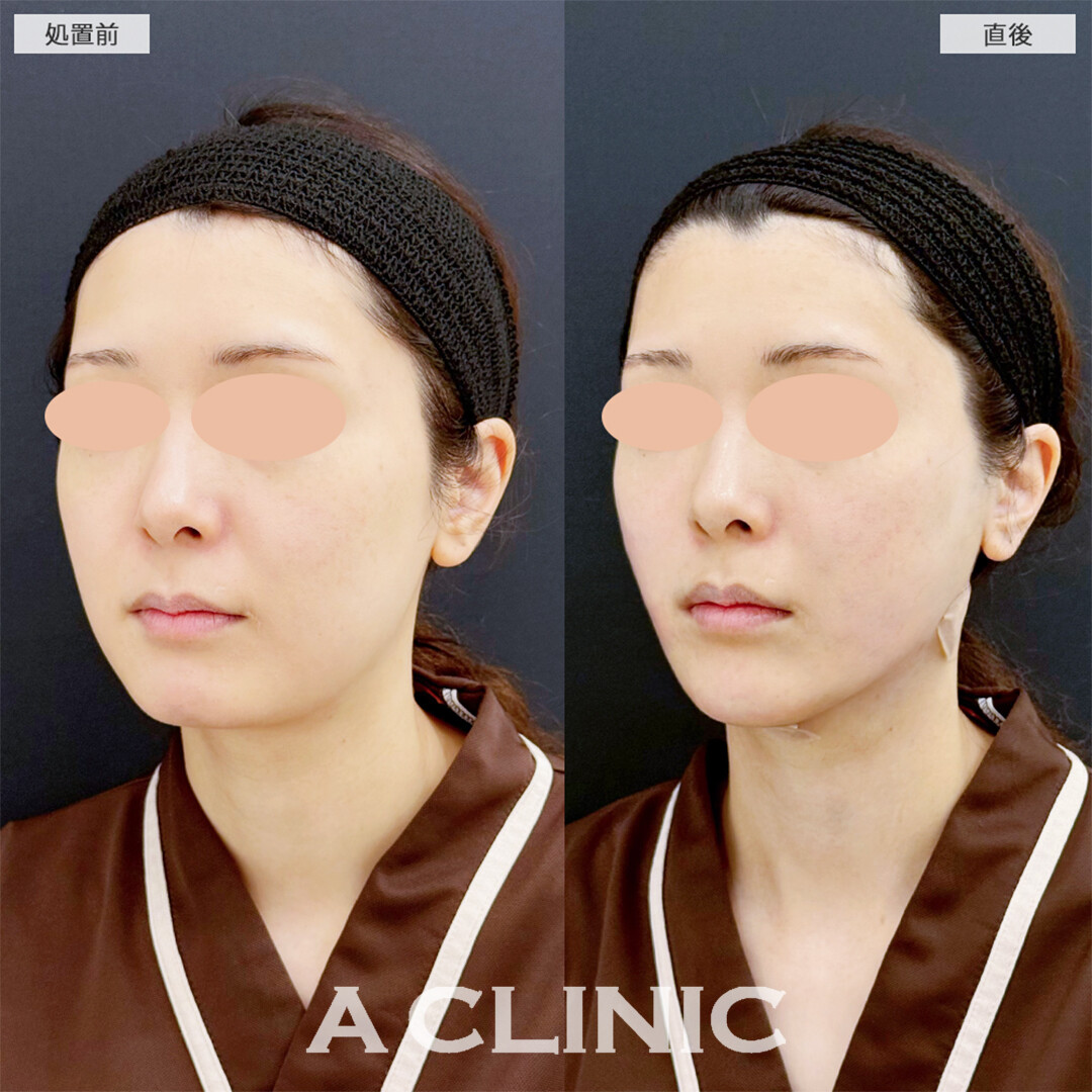 1day小顔脂肪吸引とあごへのヒアルロン酸注入は直後からVフェイスになれます！こちら処置前と直後の症例です(20代女性)