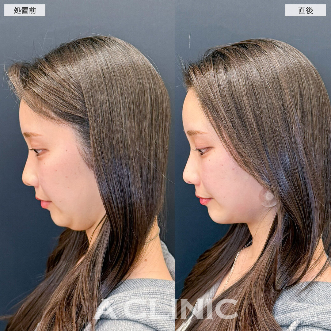 1day小顔で施術直後から写真が映える輪郭に！こちら処置前と処置直後の症例です(20代女性)