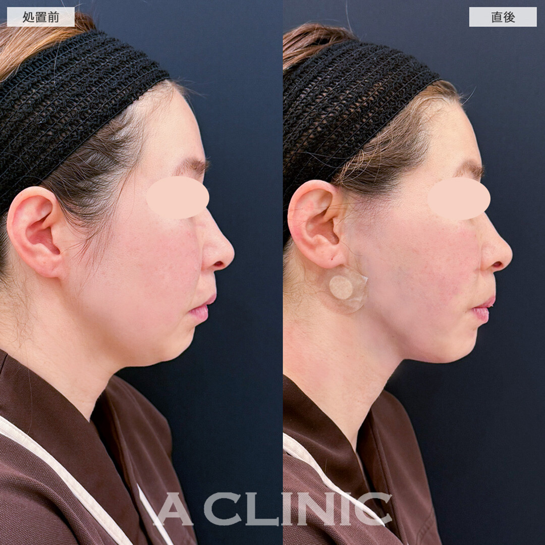 1day小顔脂肪吸引で痩せにくい顔周りや顎下のお悩みを即日解決！こちら処置前と直後の症例です(30代女性)