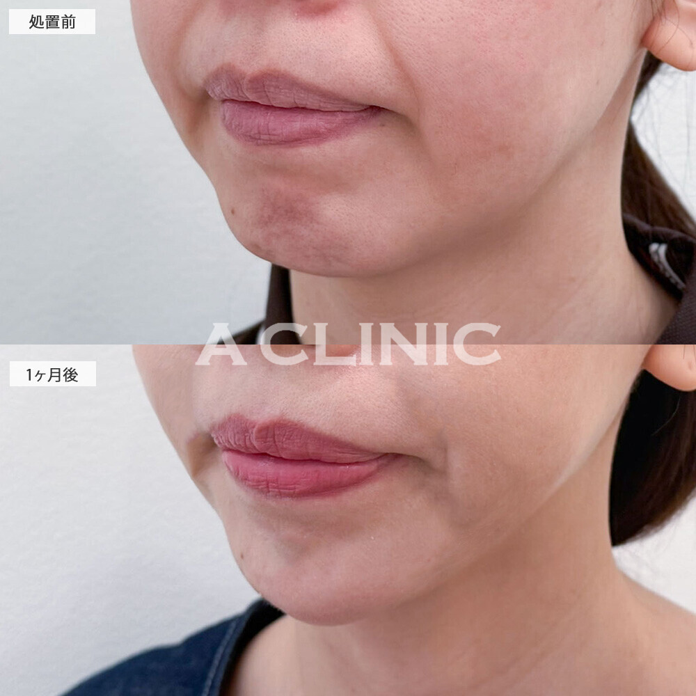 あごのボトックス注射で老けの原因のシワを改善！こちら処置前と1ヶ月後の症例です(40代女性)
