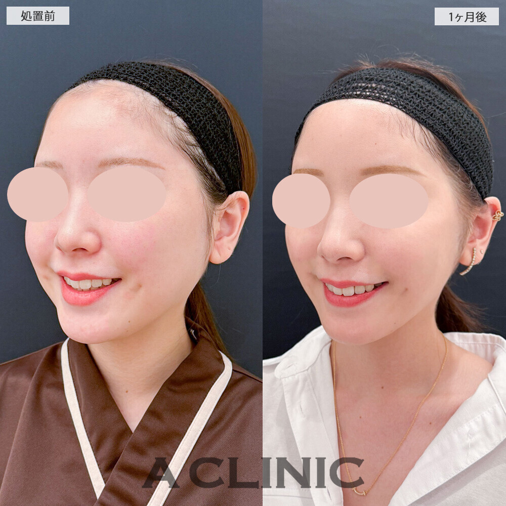 1day小顔脂肪吸引とバッカルファット除去術で別人級の輪郭に！こちら処置前から2ヶ月後の症例です(20代女性)
