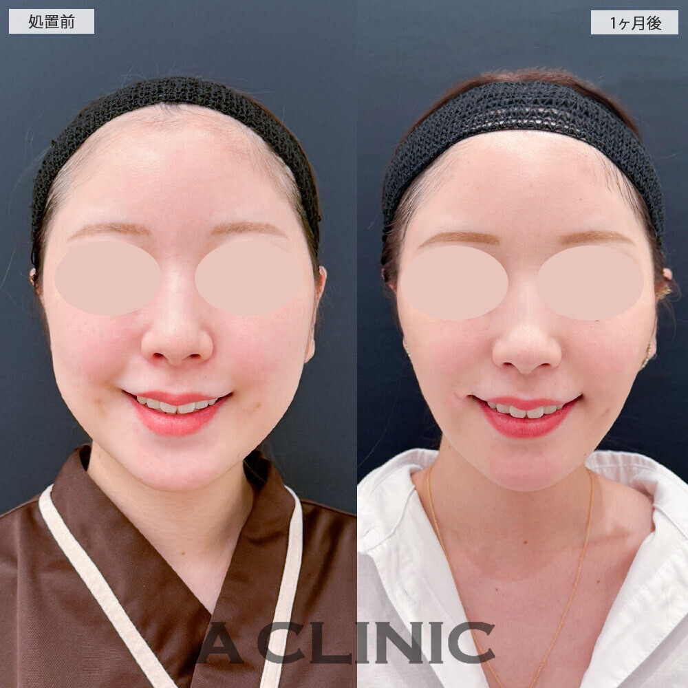 1day小顔脂肪吸引とバッカルファット除去術で別人級の輪郭に！こちら処置前から2ヶ月後の症例です(20代女性)