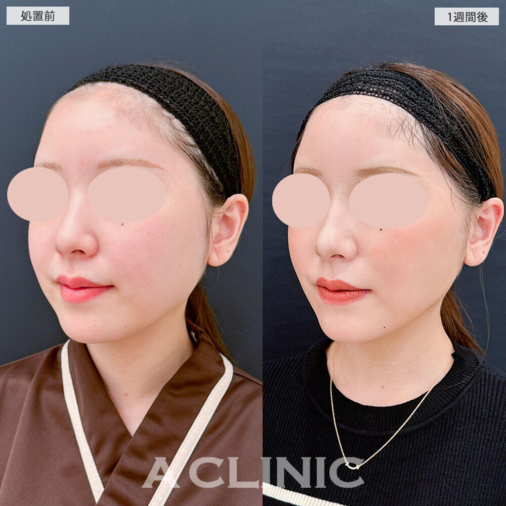 1day小顔脂肪吸引とバッカルファット除去術で頬のぷくっと感が改善！こちら処置前と1週間後の症例です(20代女性)