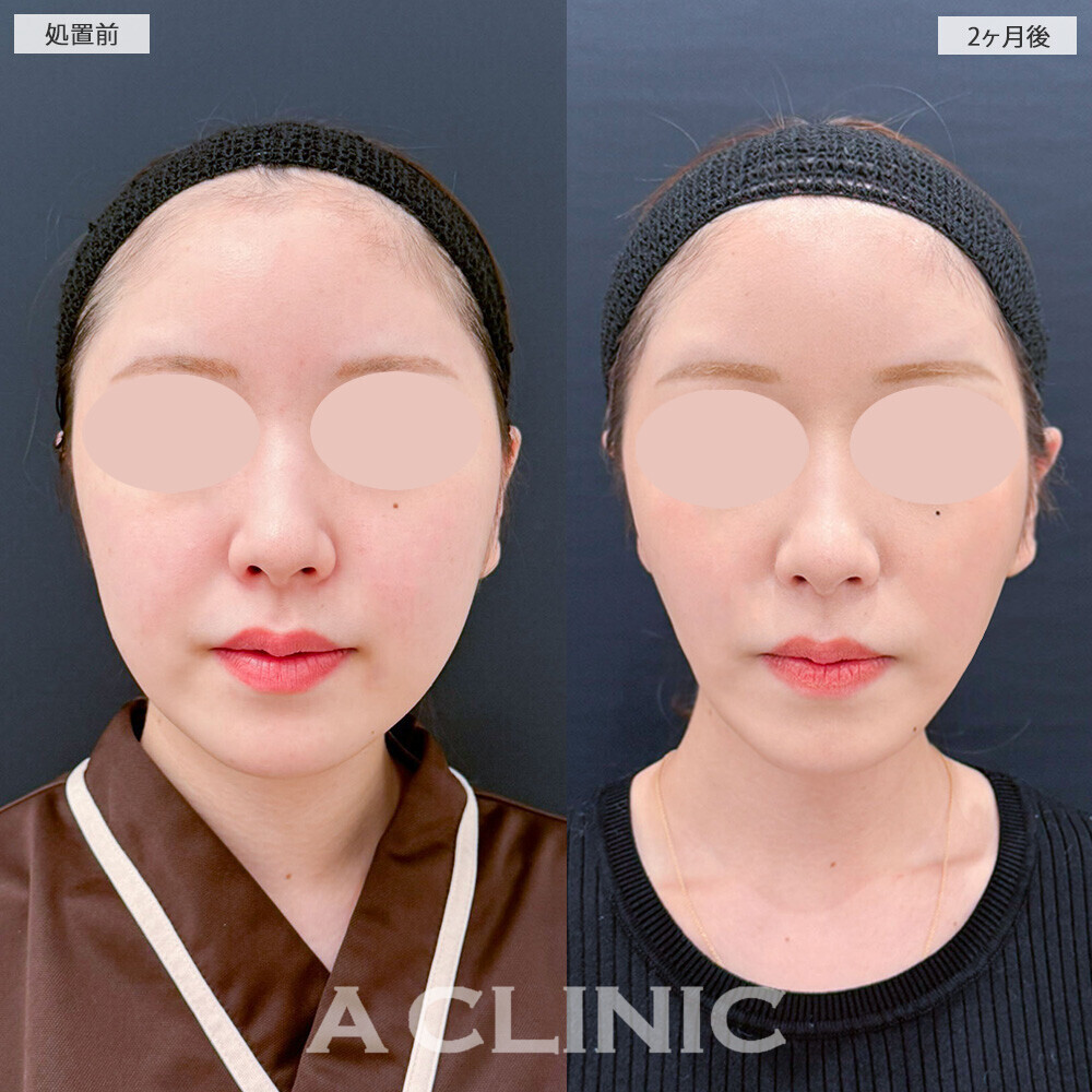 1day小顔脂肪吸引とバッカルファット除去術で別人級の輪郭に！こちら処置前から2ヶ月後の症例です(20代女性)