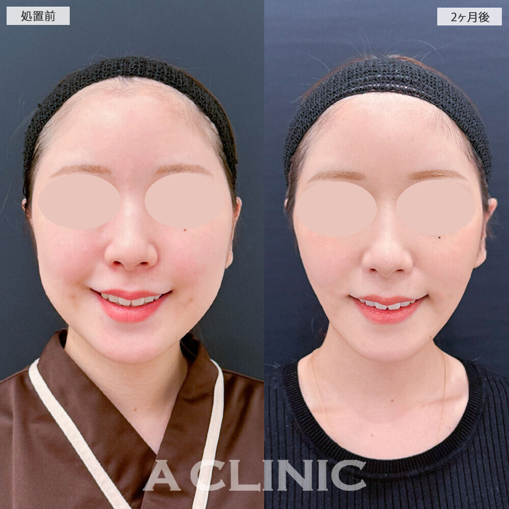 1day小顔脂肪吸引とバッカルファット除去術で別人級の輪郭に！こちら処置前から2ヶ月後の症例です(20代女性)