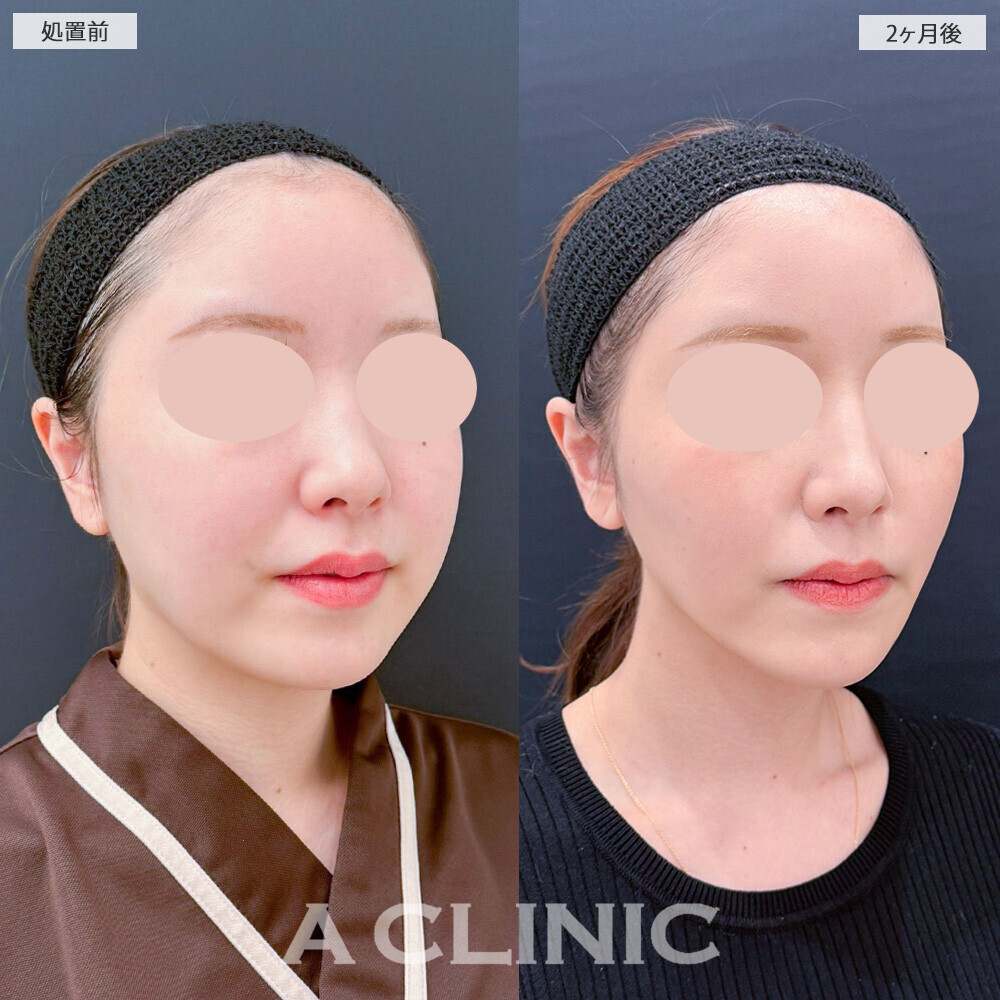 1day小顔脂肪吸引とバッカルファット除去術で別人級の輪郭に！こちら処置前から2ヶ月後の症例です(20代女性)