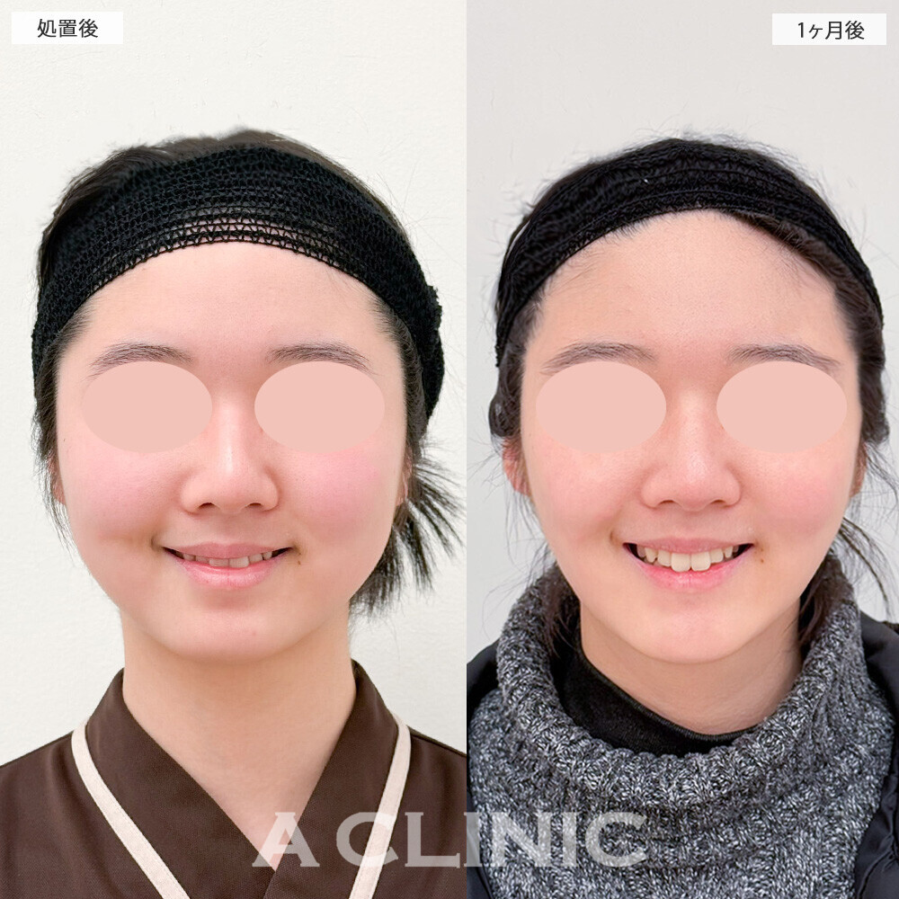 1day小顔脂肪吸引とバッカルファット除去術で頬のぷっくり感改善！こちら処置前から3ヶ月後の症例です(10代女性)