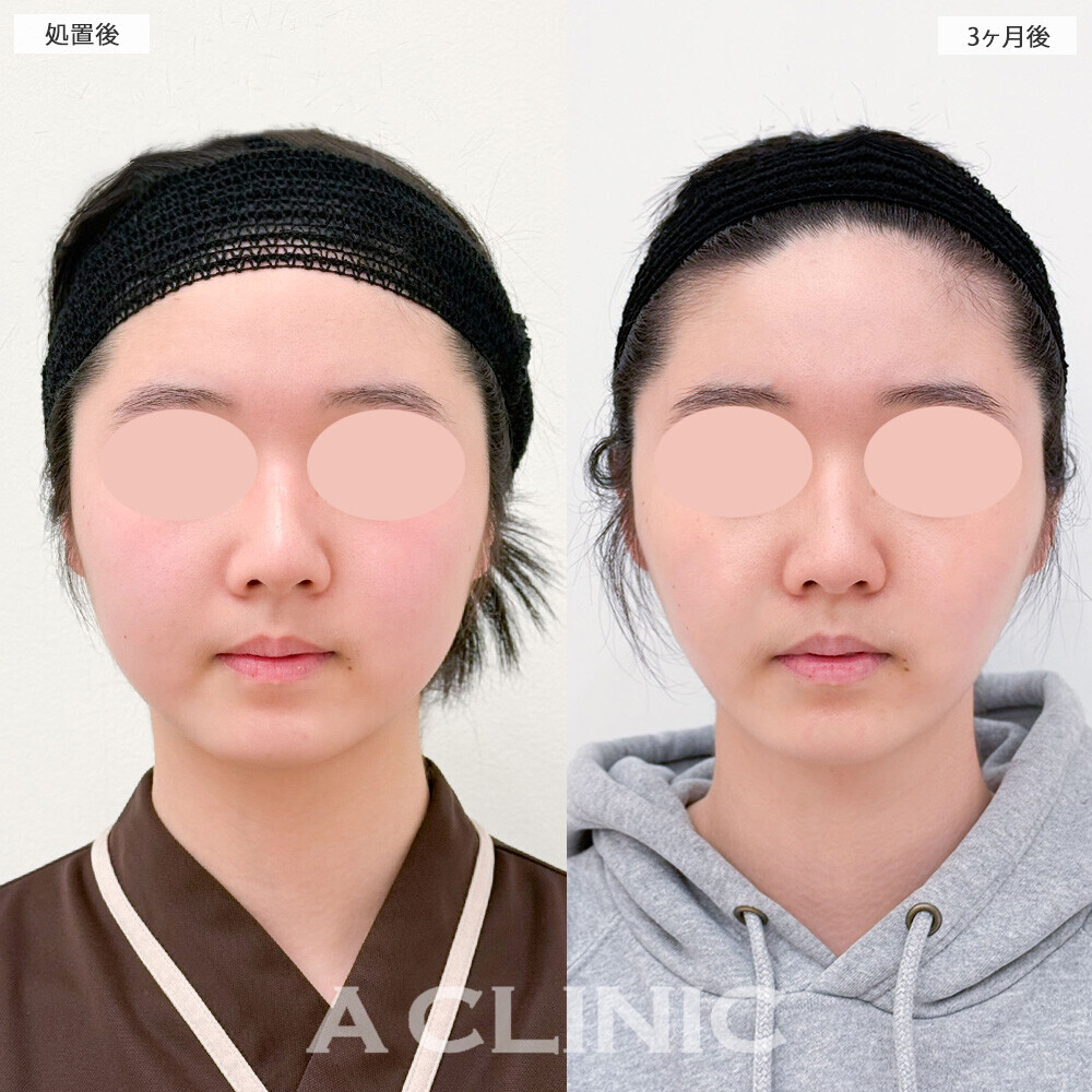 1day小顔脂肪吸引とバッカルファット除去術で頬のぷっくり感改善！こちら処置前から3ヶ月後の症例です(10代女性)