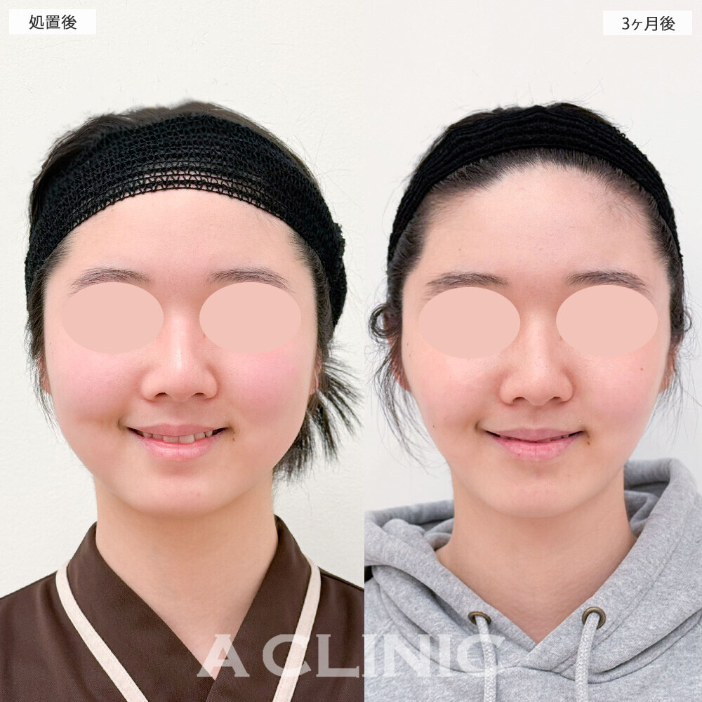 1day小顔脂肪吸引とバッカルファット除去術で頬のぷっくり感改善！こちら処置前から3ヶ月後の症例です(10代女性)