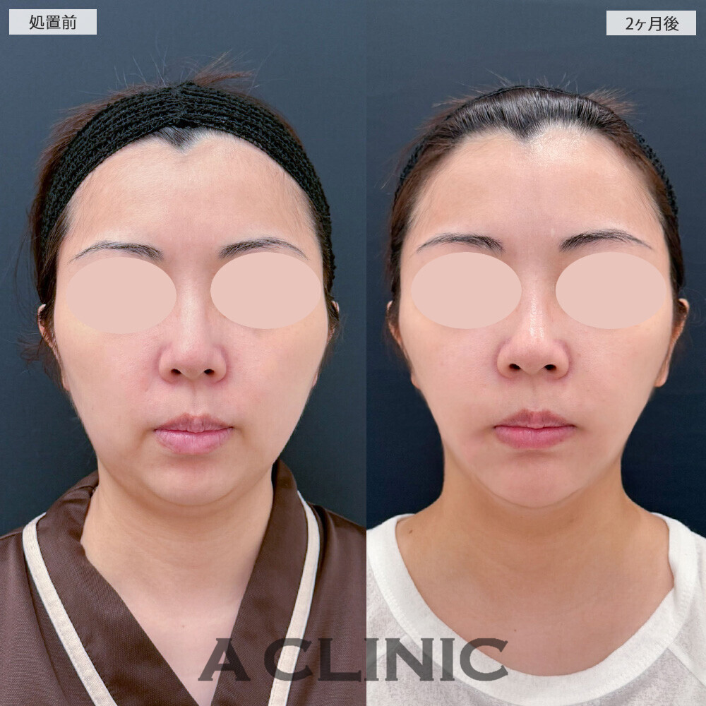 1day小顔脂肪吸引と小顔エラボトックスで二重あごが気にならなくなりました！こちら処置前から2ヶ月後の症例です(30代女性)