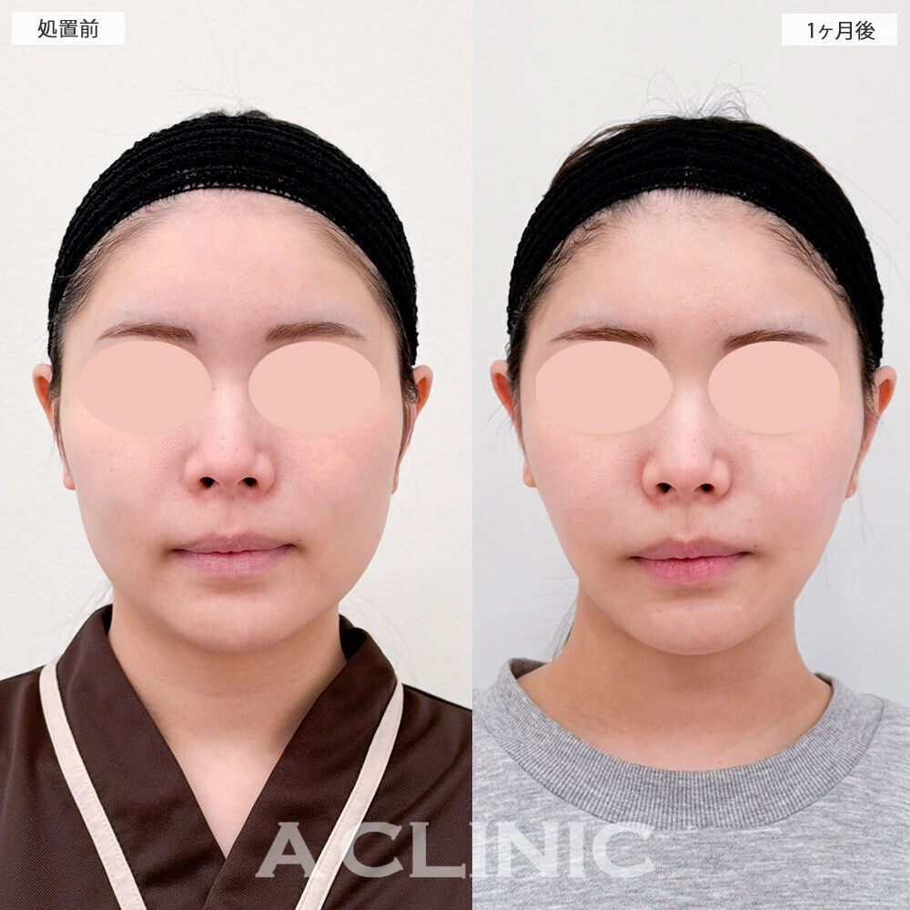 1day小顔脂肪吸引と小顔エラボトックスで丸顔がスッキリとしたフェイスラインに！こちら処置前から2ヶ月後の症例です(20代女性)