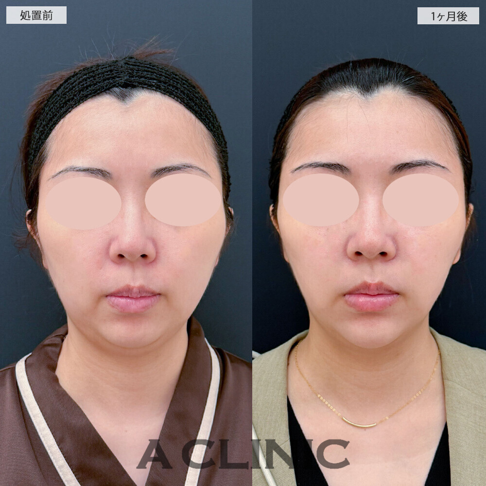 1day小顔脂肪吸引と小顔エラボトックスで二重あごが気にならなくなりました！こちら処置前から2ヶ月後の症例です(30代女性)