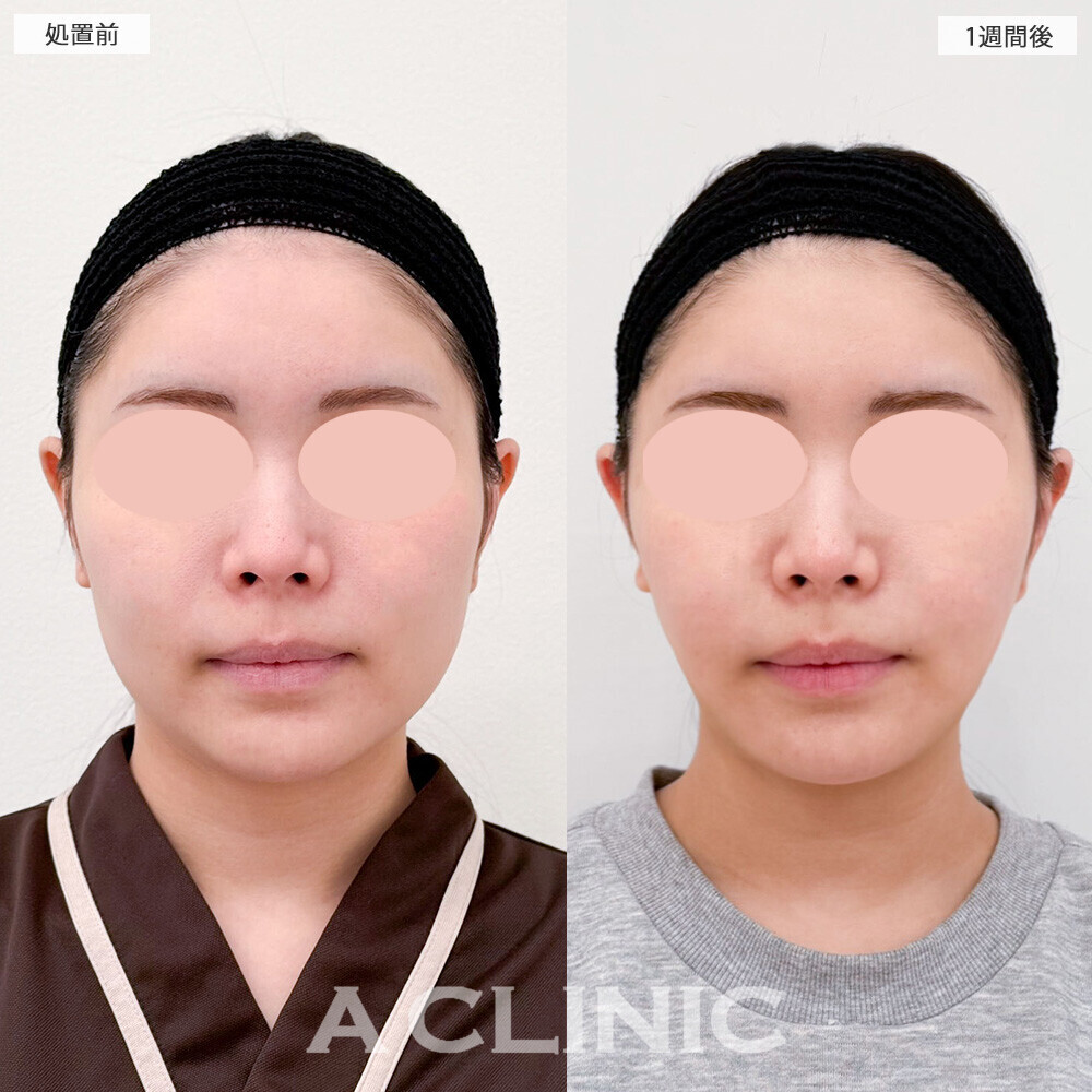 1day小顔脂肪吸引と小顔エラボトックスで丸顔がスッキリとしたフェイスラインに！こちら処置前から2ヶ月後の症例です(20代女性)