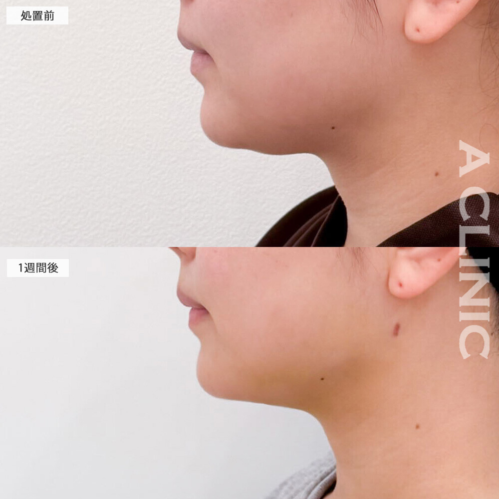 1day小顔脂肪吸引と小顔エラボトックスで丸顔がスッキリとしたフェイスラインに！こちら処置前から2ヶ月後の症例です(20代女性)