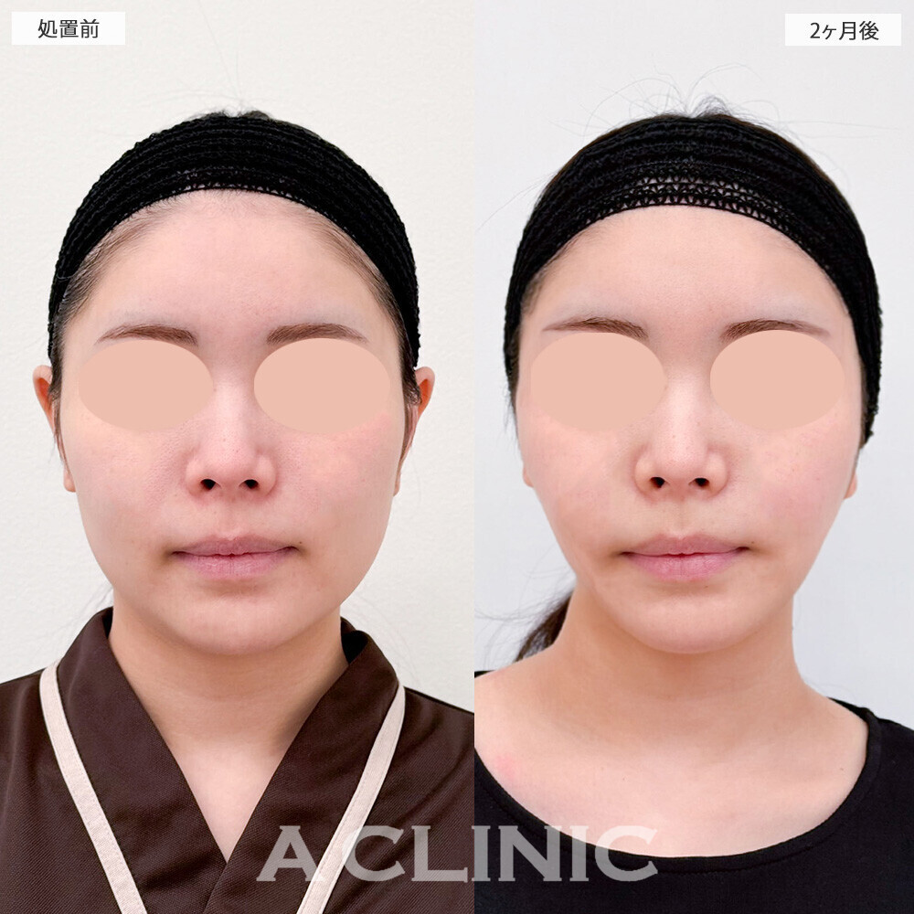 1day小顔脂肪吸引と小顔エラボトックスで丸顔がスッキリとしたフェイスラインに！こちら処置前から2ヶ月後の症例です(20代女性)