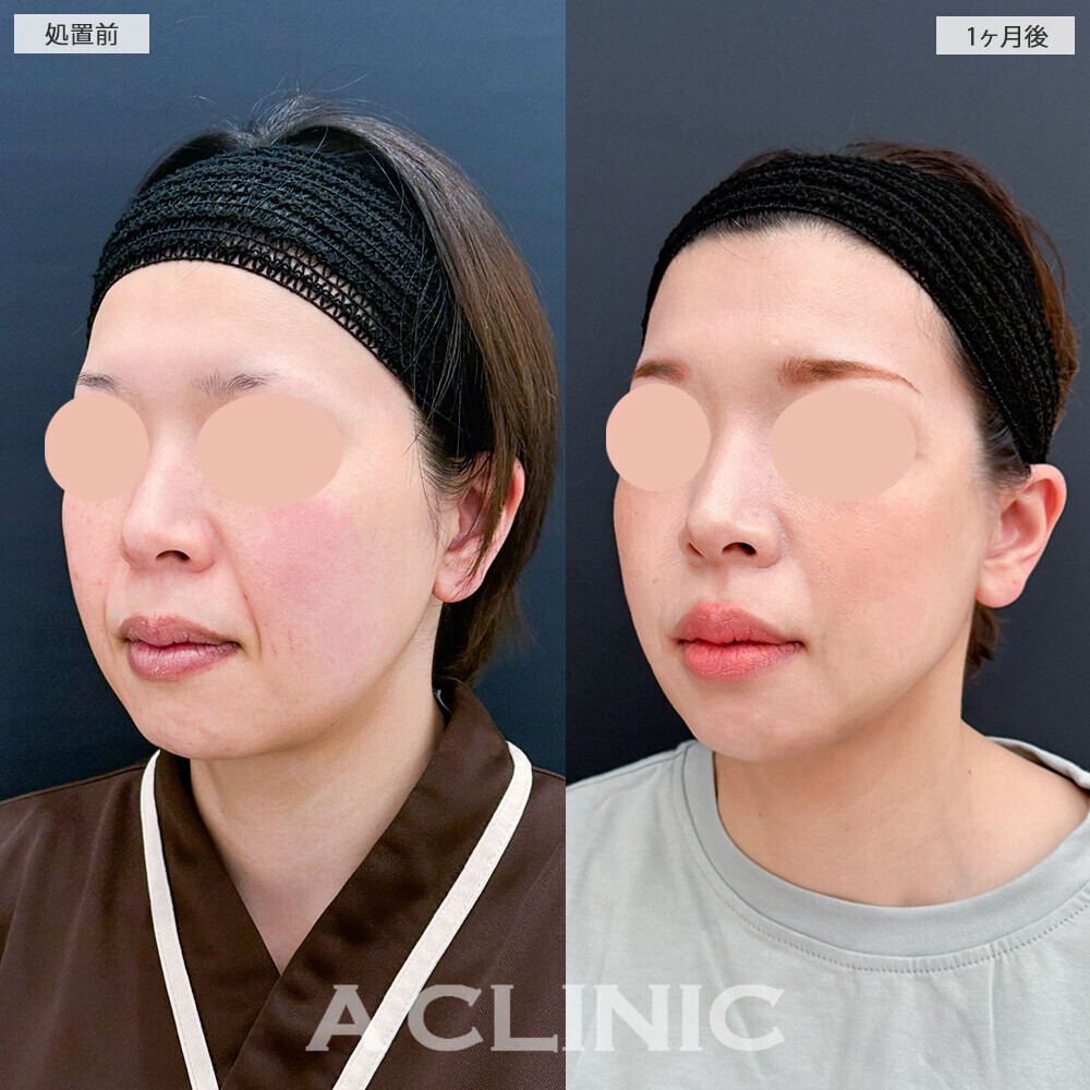 1day小顔脂肪吸引とA式美肌たるみ切開でたるみをしっかり引き上げました！こちら処置前から2ヶ月後の症例です(40代女性)