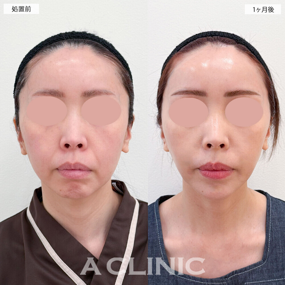 1day小顔脂肪吸引とA式美肌たるみ切開とあごへのヒアルロン酸注入で輪郭がスッキリ整いました！こちら処置前から6ヶ月後の症例です(40代女性)