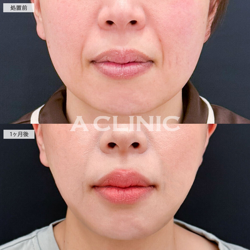 1day小顔脂肪吸引とA式美肌たるみ切開でたるみをしっかり引き上げました！こちら処置前から2ヶ月後の症例です(40代女性)