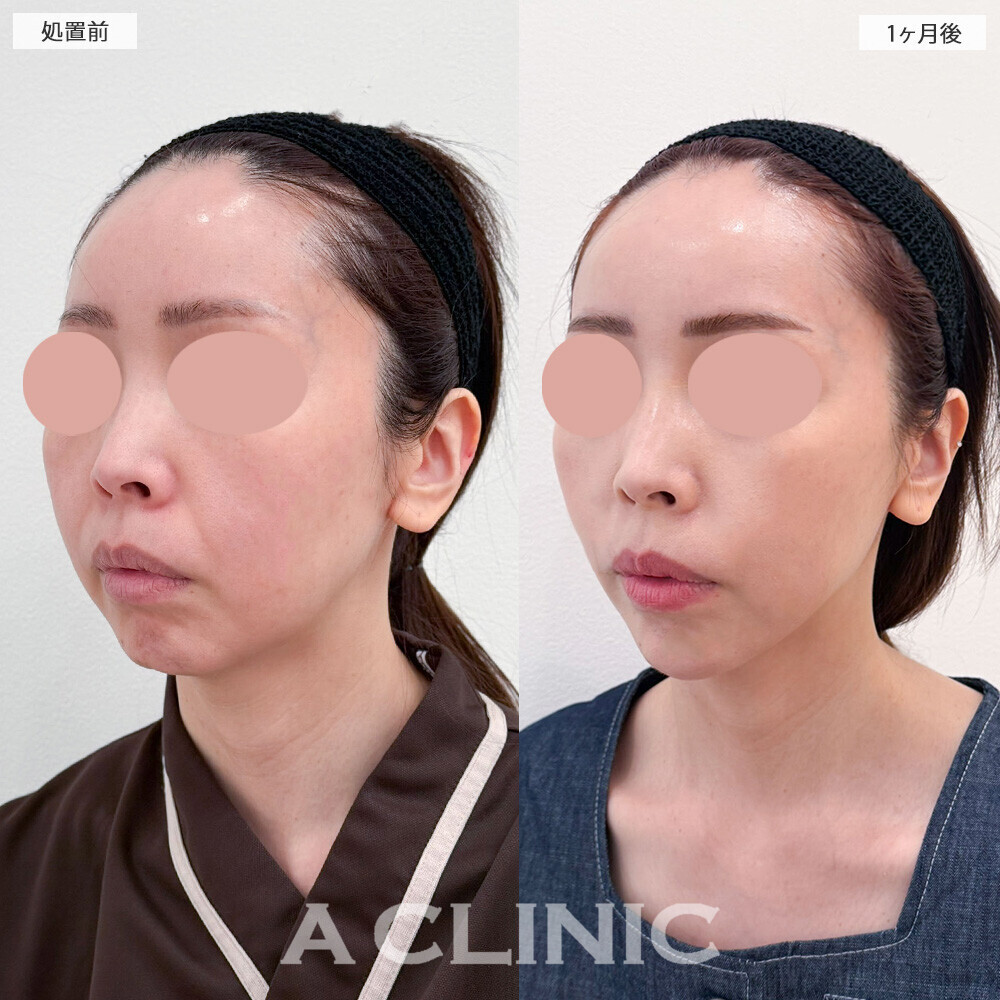 1day小顔脂肪吸引とA式美肌たるみ切開とあごへのヒアルロン酸注入で輪郭がスッキリ整いました！こちら処置前から6ヶ月後の症例です(40代女性)