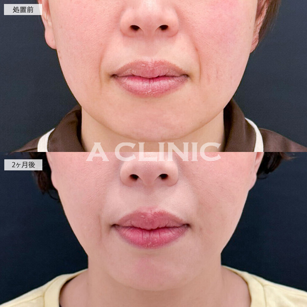 1day小顔脂肪吸引とA式美肌たるみ切開でたるみをしっかり引き上げました！こちら処置前から2ヶ月後の症例です(40代女性)