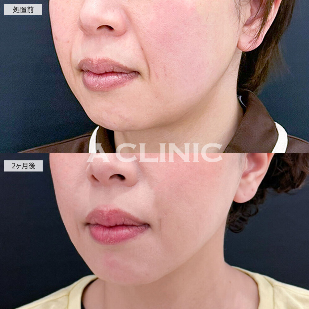 1day小顔脂肪吸引とA式美肌たるみ切開でたるみをしっかり引き上げました！こちら処置前から2ヶ月後の症例です(40代女性)