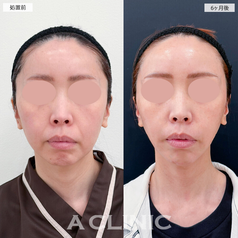 1day小顔脂肪吸引とA式美肌たるみ切開とあごへのヒアルロン酸注入で輪郭がスッキリ整いました！こちら処置前から6ヶ月後の症例です(40代女性)