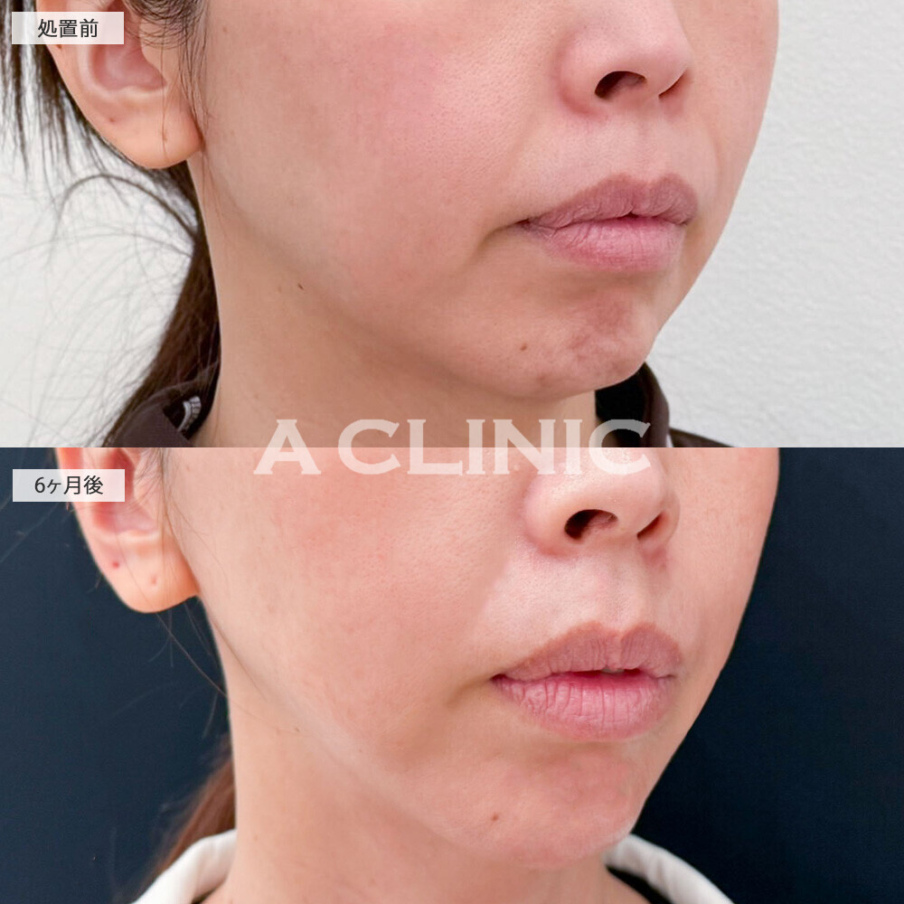 1day小顔脂肪吸引とA式美肌たるみ切開とあごへのヒアルロン酸注入で輪郭がスッキリ整いました！こちら処置前から6ヶ月後の症例です(40代女性)