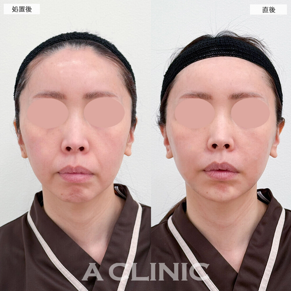1day小顔脂肪吸引とA式美肌たるみ切開とあごへのヒアルロン酸注入で輪郭がスッキリ整いました！こちら処置前から6ヶ月後の症例です(40代女性)