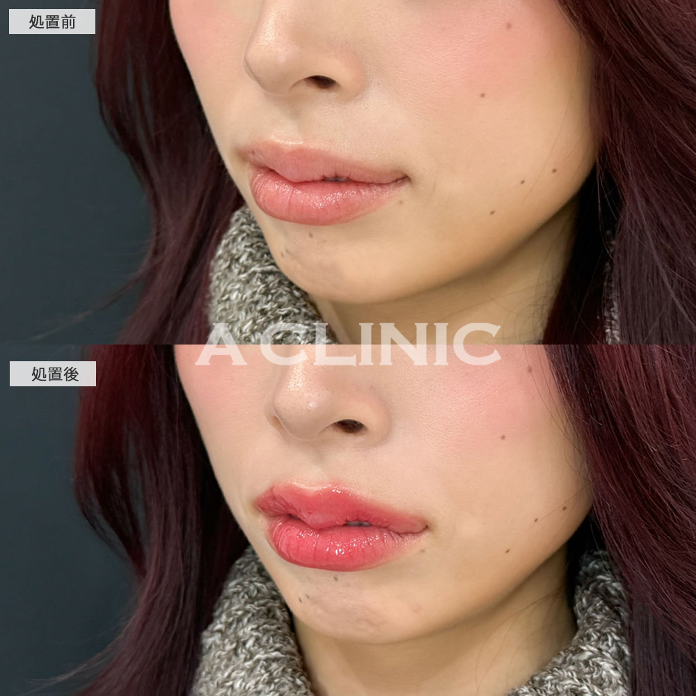 スマイルリップでぷっくりした存在感のある唇に変化！こちら施術前と直後の症例です(20代女性)