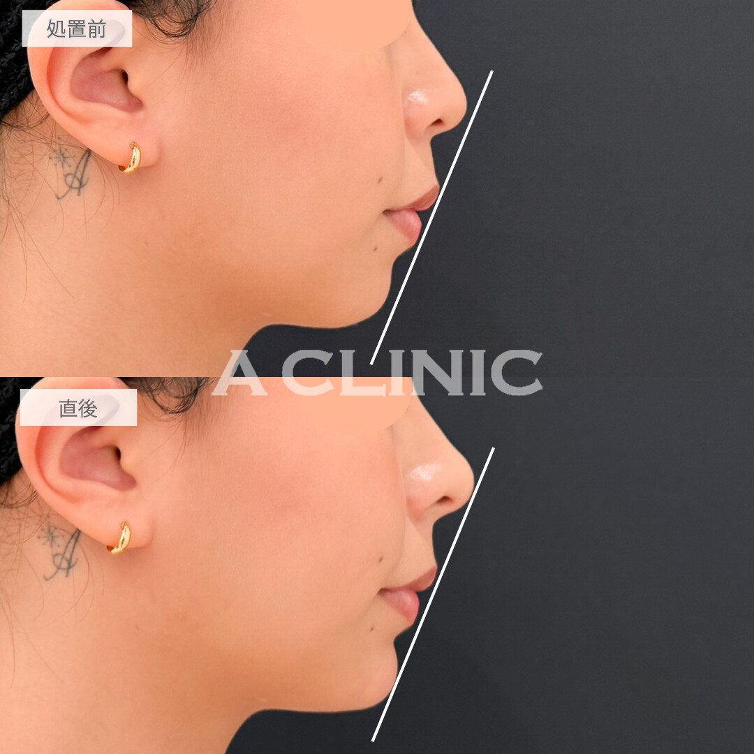 鼻ヒアルロン酸とあごへのヒアルロン酸注入でEライン形成と人中短縮が両方叶いました！処置前と直後の症例です(20代女性)