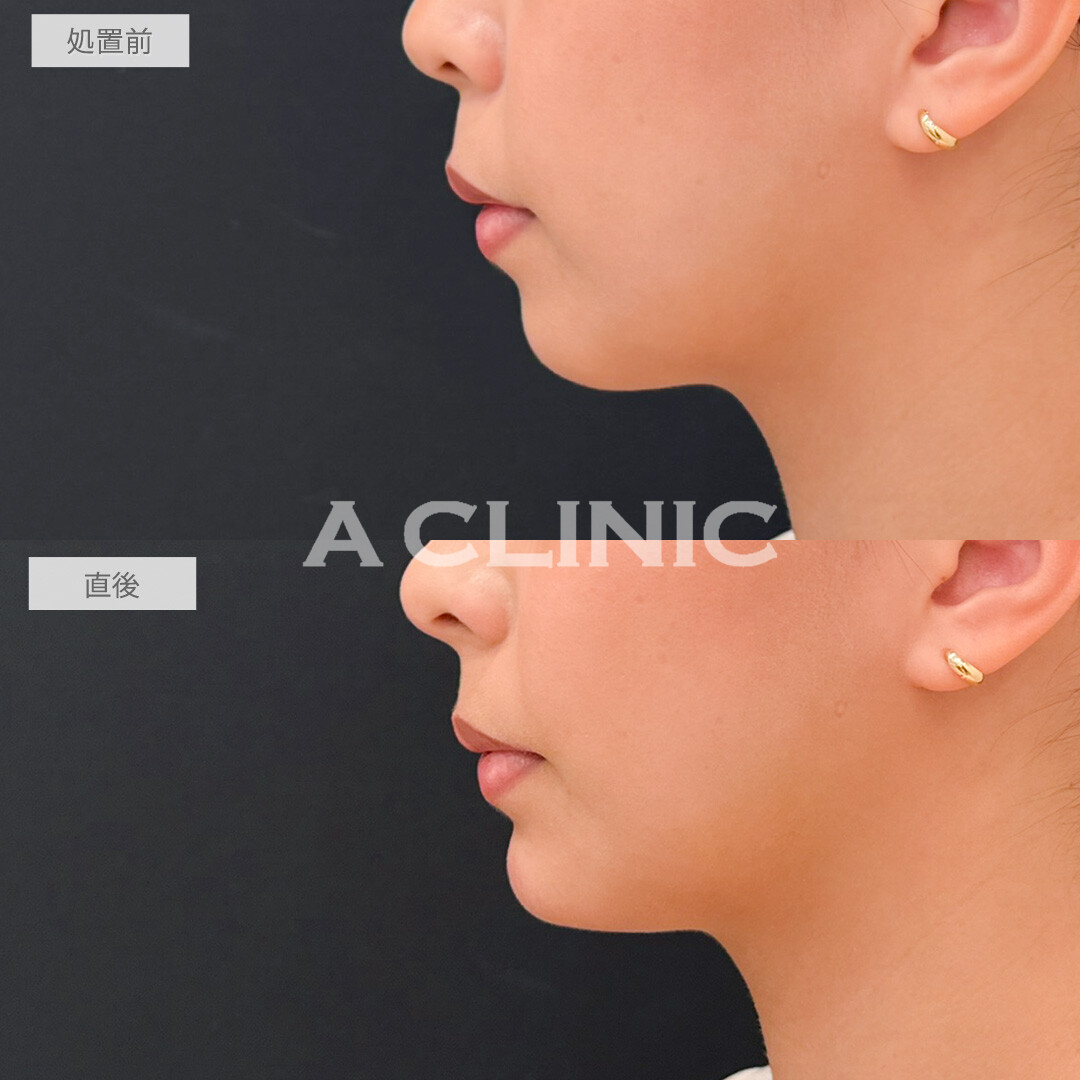 鼻ヒアルロン酸とあごへのヒアルロン酸注入でEライン形成と人中短縮が両方叶いました！処置前と直後の症例です(20代女性)