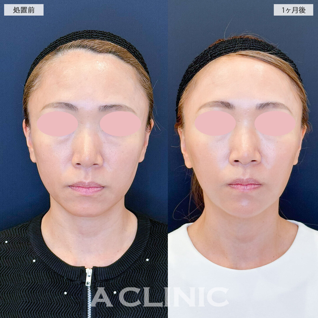 Aスレッドで憧れのいちごフェイスに！こちら処置前と1ヶ月後の症例です(40代女性)