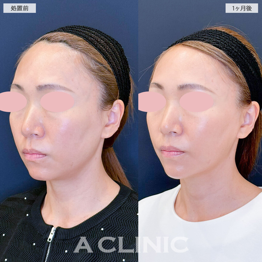 Aスレッドで憧れのいちごフェイスに！こちら処置前と1ヶ月後の症例です(40代女性)