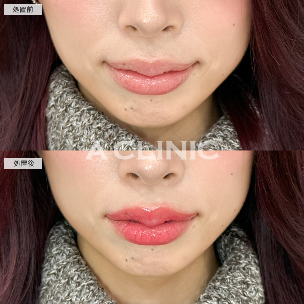 スマイルリップでぷっくりした存在感のある唇に変化！こちら施術前と直後の症例です(20代女性)