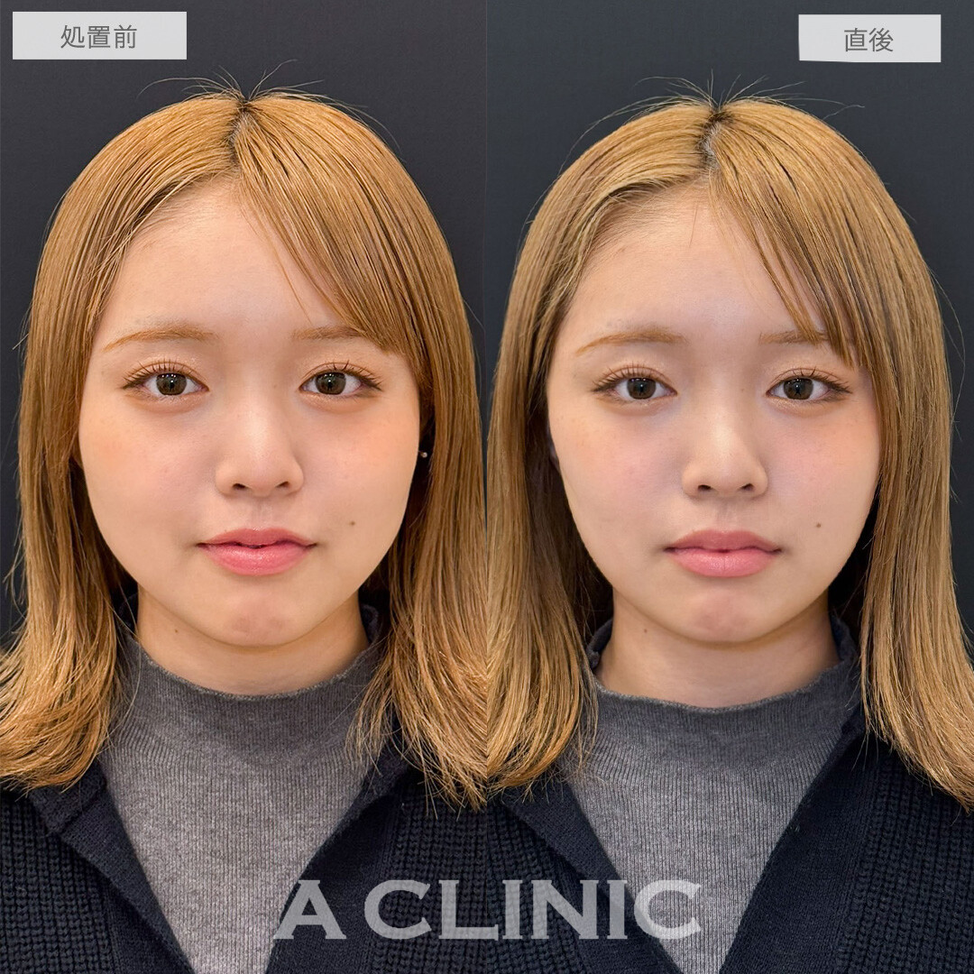 Aスレッドで口横のもたつきとほうれい線改善しました！こちら処置前と直後の症例です(20代女性)