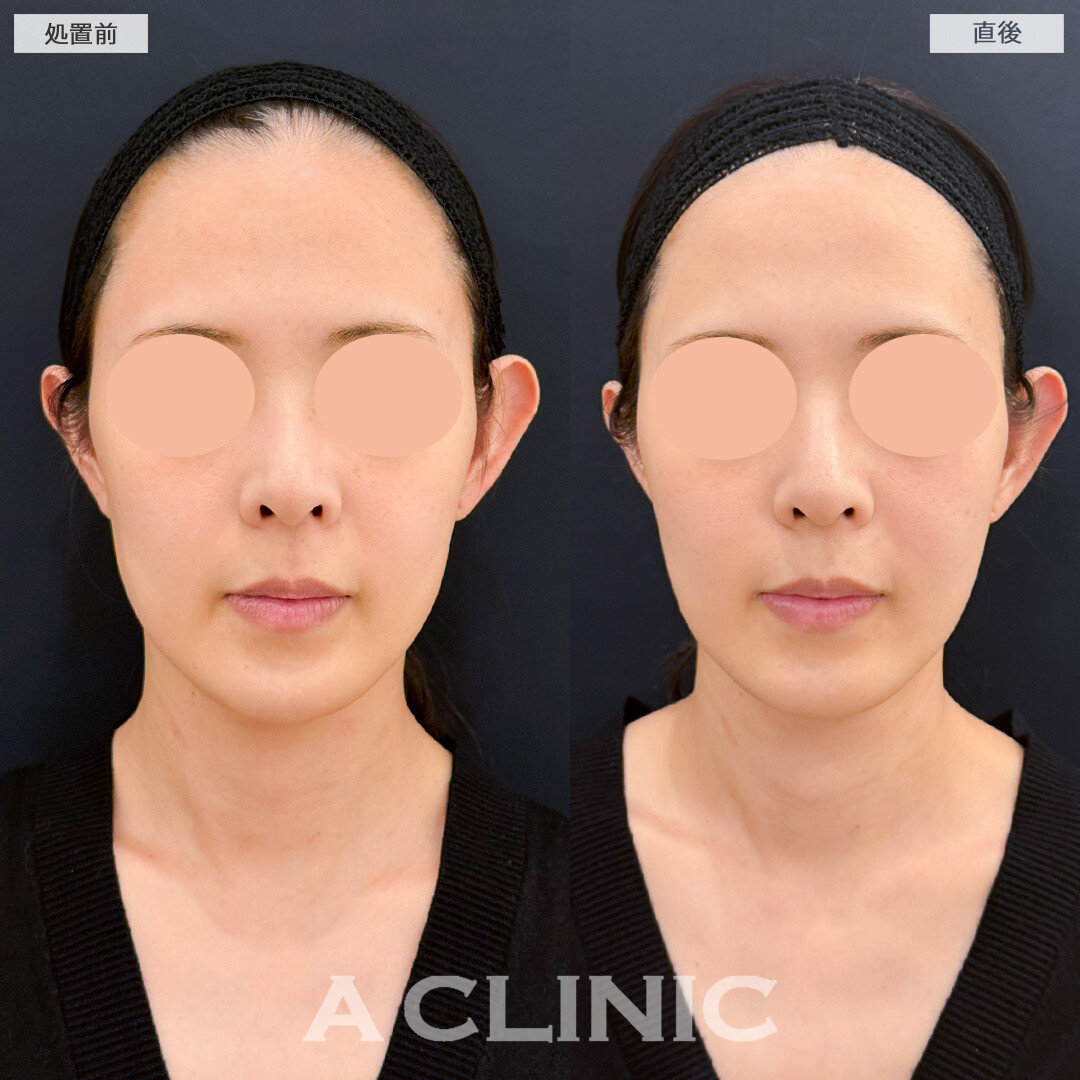 XERF(ザーフ)で口横のもたつきが自然にスッキリしました！処置前と直後の症例です(30代女性)