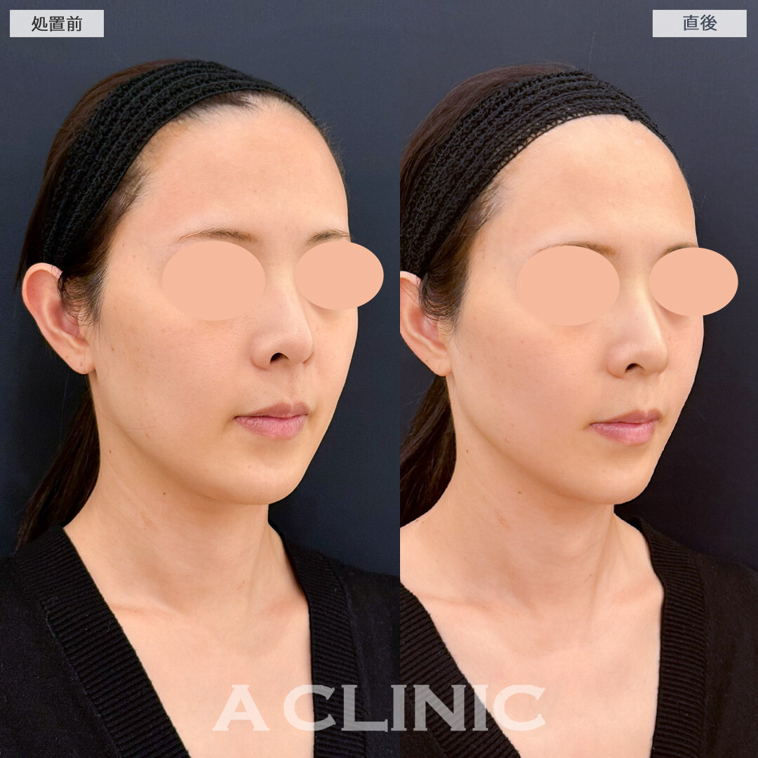 XERF(ザーフ)で口横のもたつきが自然にスッキリしました！処置前と直後の症例です(30代女性)