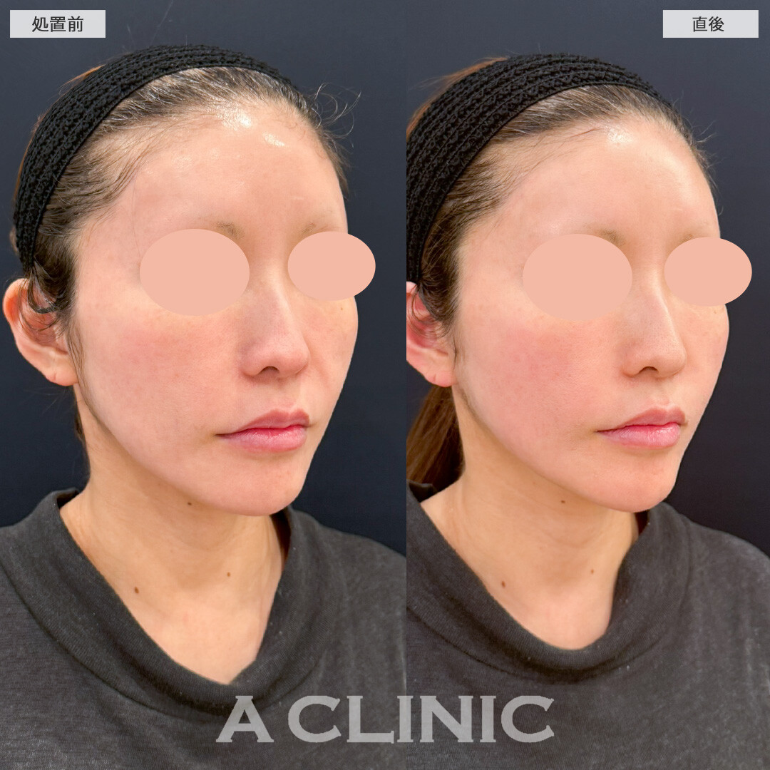 XERF(ザーフ)で定期メンテナンスをしてたるみのない肌を保てます！処置前と直後の症例です(40代女性)