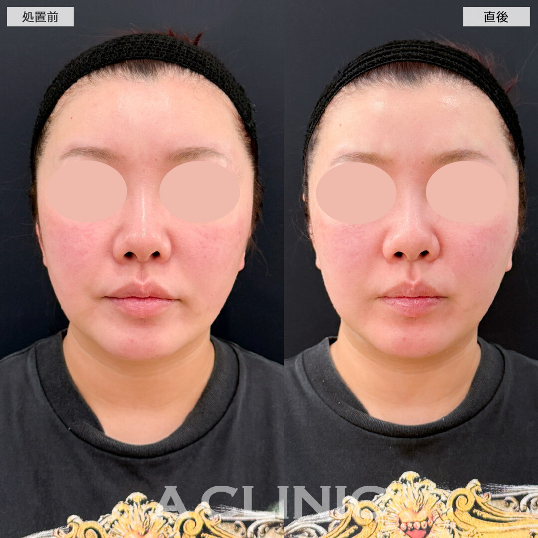 XERF(ザーフ)で周りにバレにくい自然なたるみ治療ができます！処置前と直後の症例です(40代女性)