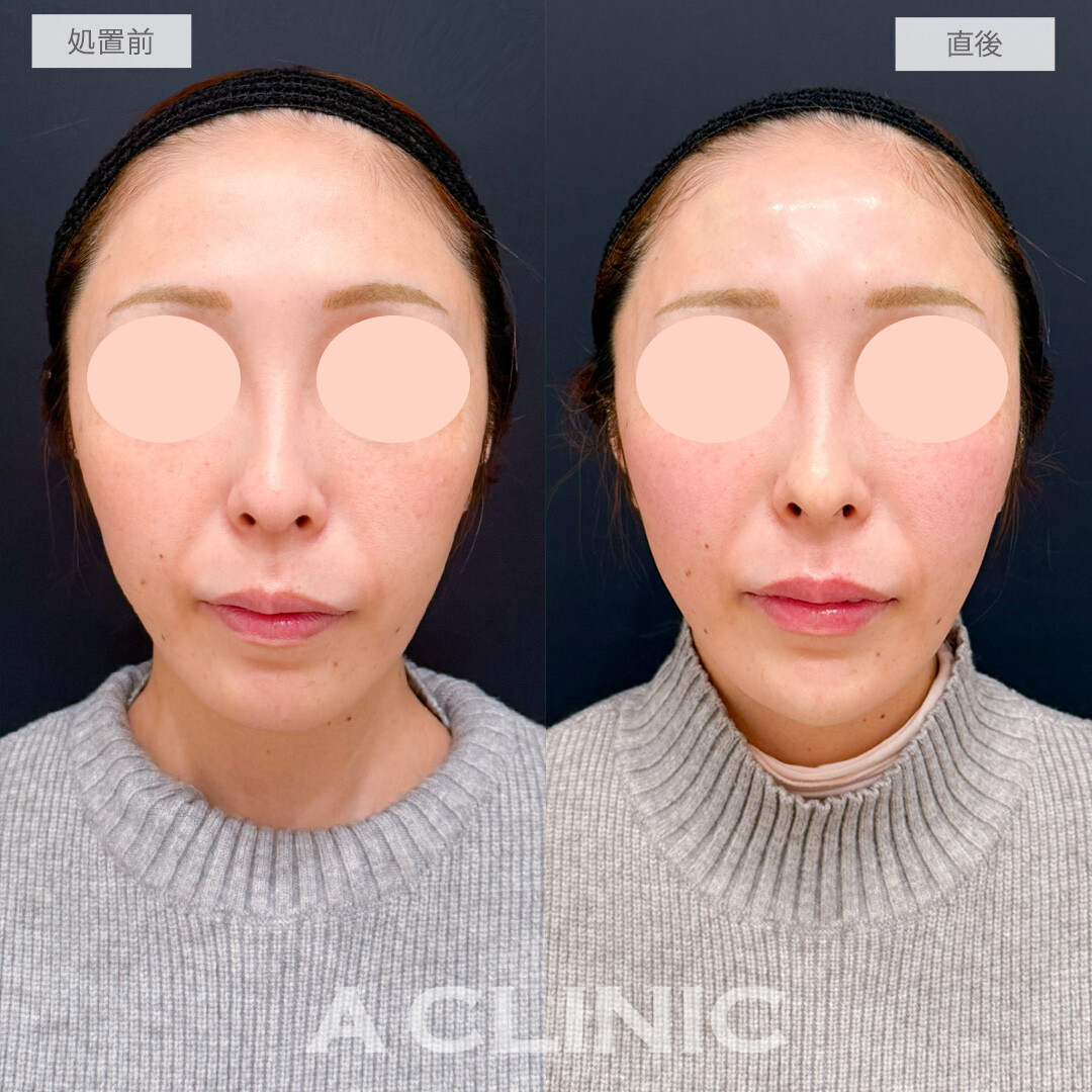 コリアンノーズやあごへのヒアルロン酸注入でEラインやお顔の歪みが整いました！処置前と直後の症例です(30代女性)