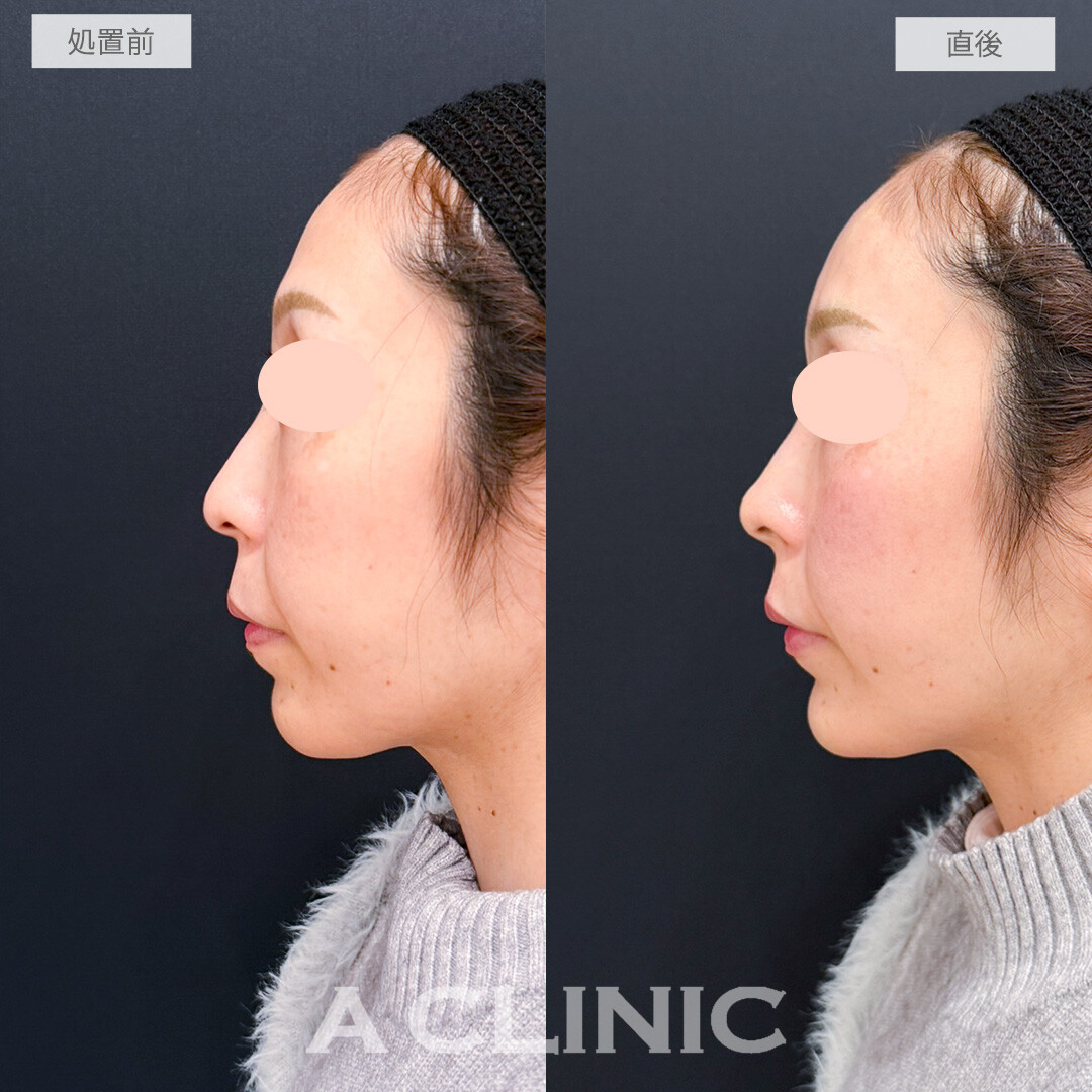 コリアンノーズやあごへのヒアルロン酸注入でEラインやお顔の歪みが整いました！処置前と直後の症例です(30代女性)