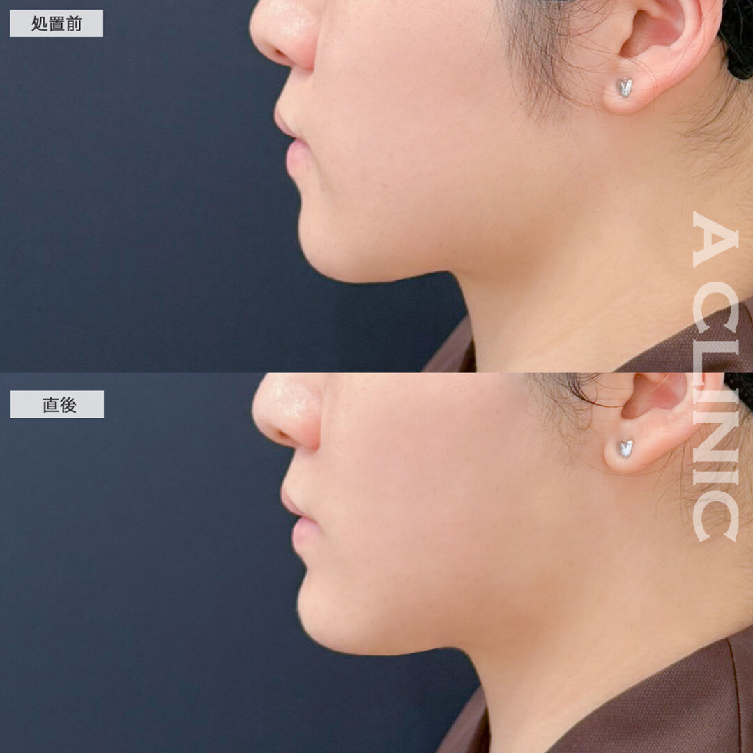 あごへのヒアルロン酸注入で横顔が立体的になりました！こちら処置前と直後の症例です(20代女性)