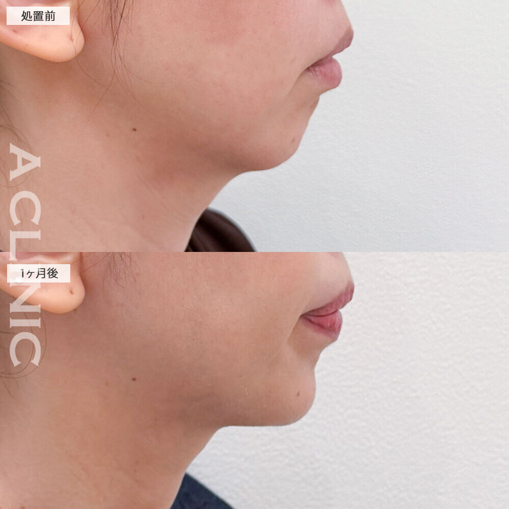 1day小顔脂肪吸引とA式美肌たるみ切開とあごへのヒアルロン酸注入で輪郭がスッキリ整いました！こちら処置前から6ヶ月後の症例です(40代女性)