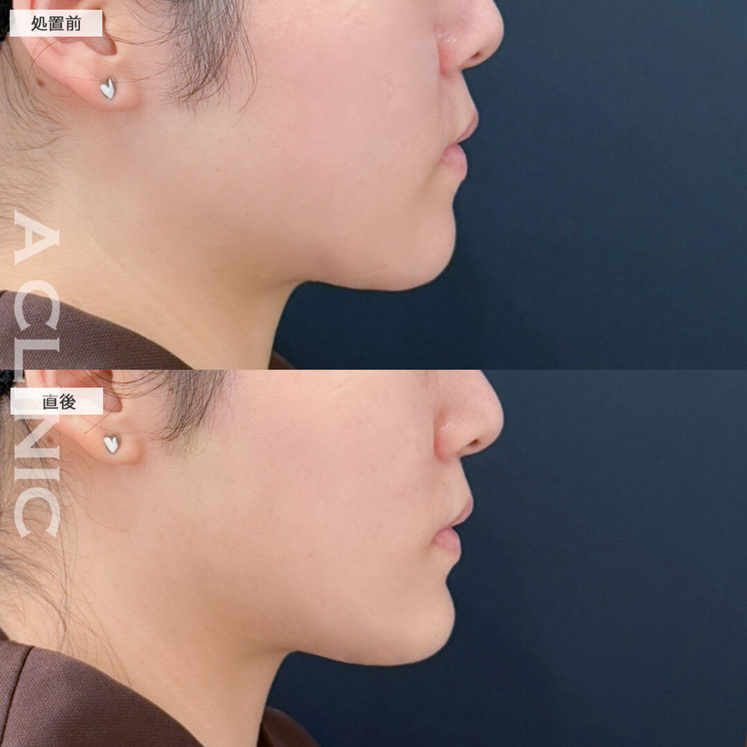 あごへのヒアルロン酸注入で横顔が立体的になりました！こちら処置前と直後の症例です(20代女性)