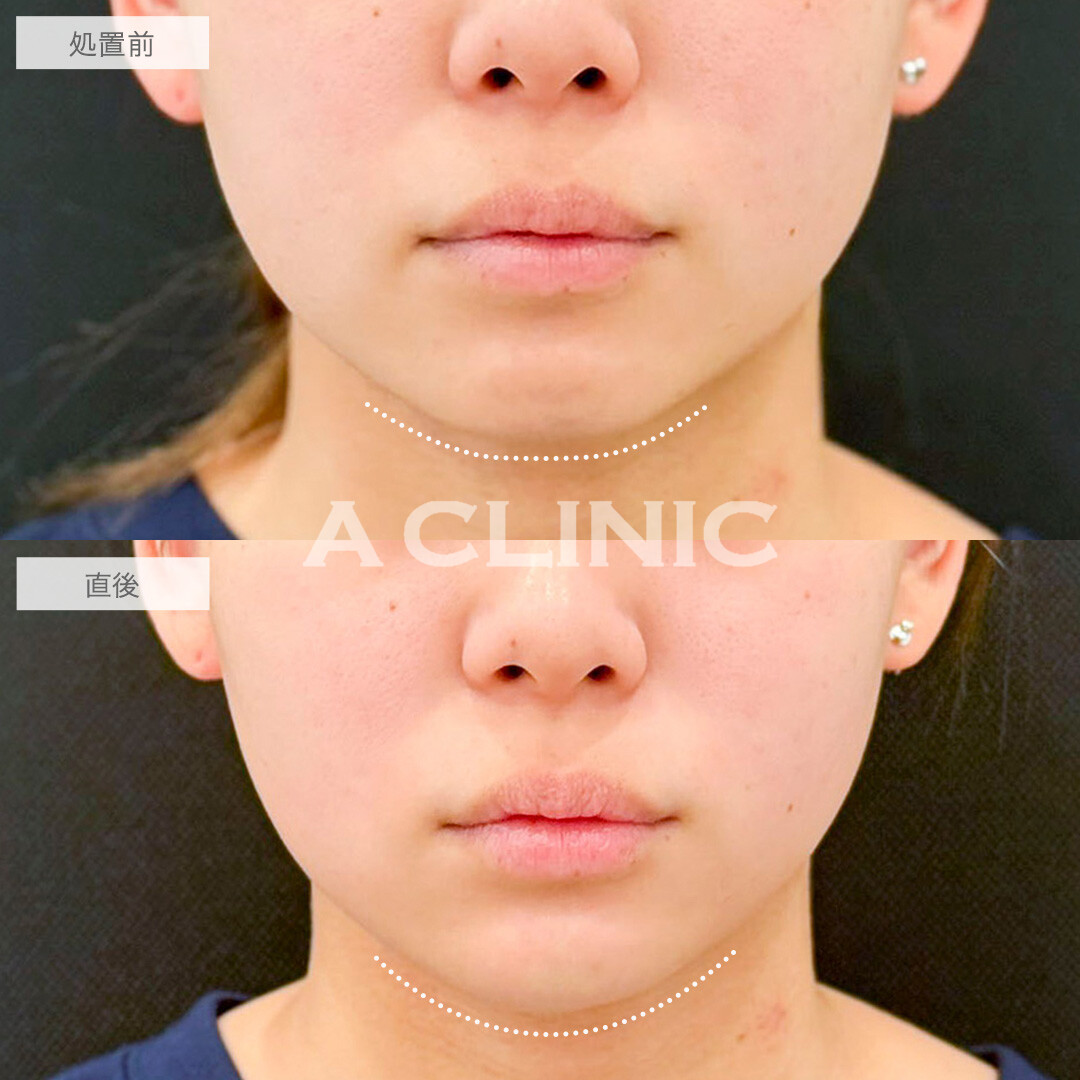あごへのヒアルロン酸注入で美しいEラインを形成！処置前と直後の症例です(20代女性)