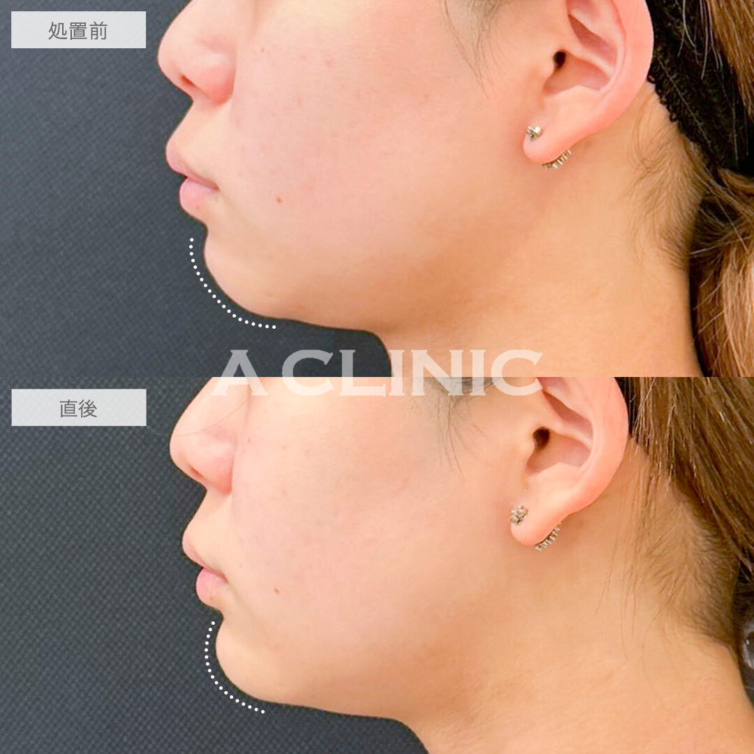 あごへのヒアルロン酸注入で美しいEラインを形成！処置前と直後の症例です(20代女性)