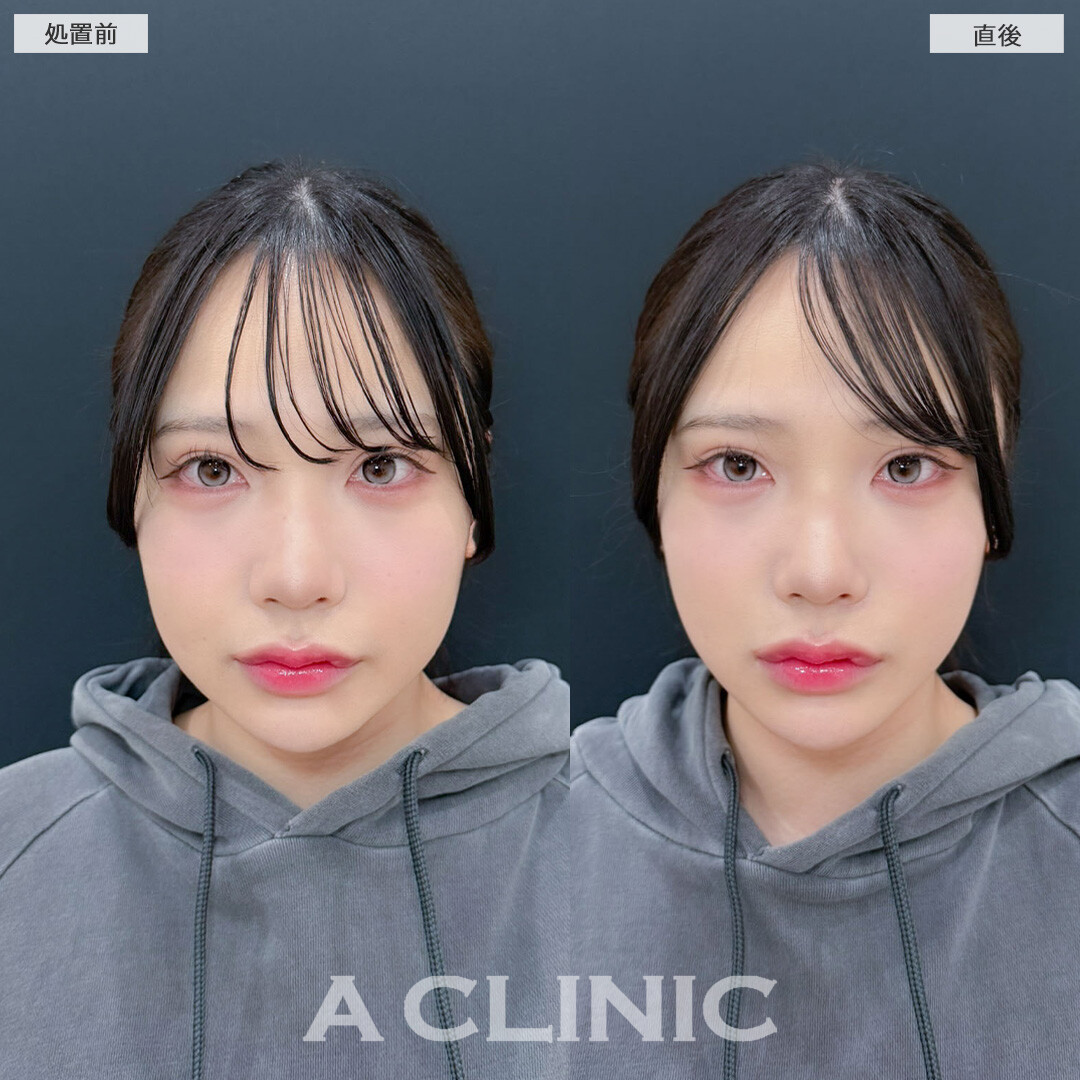 Aスレッドでしっかり引き上げフェイスラインがスッキリしました！こちら処置前と直後の症例です(20代女性)
