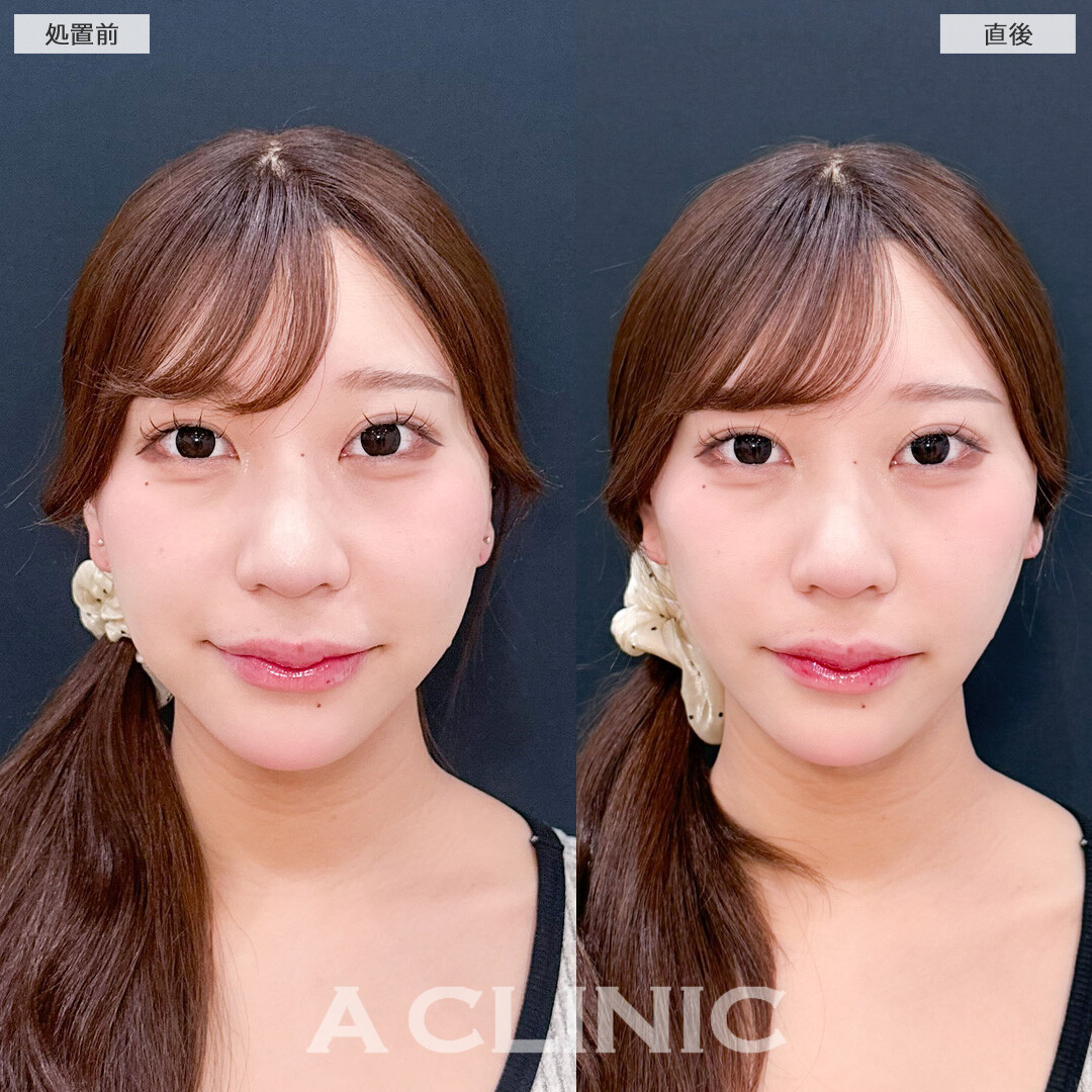 Aスレッドでフェイスラインを整えて自然に垢抜けました！こちら処置前と直後の症例です(20代女性)