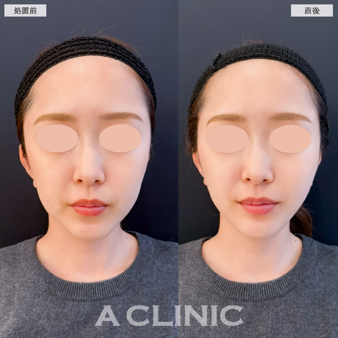 Aスレッドは皮膚が柔らかくたるみやすい方におすすめの施術です！こちら処置前と直後の症例です(20代女性)